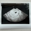 마마파파베이비산부인과의원 | 난임일기 2. 마마파파베이비 동결이식 2차 성공 후기 👼🏻