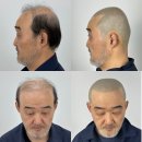 상승카클리닉 | 두피문신: 현대인의 탈모 고민을 해결하는 최고의 선택