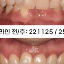 평택아름다운치과의원 네이버블로그