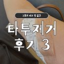 연세스타피부과의원 | 신촌 연세스타피부과 타투 제거 3회차 후기(전후 비교, 통증, 관리)