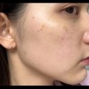 팀의원 | 주근깨제거 레이저 시술 4번째 줌패스//전후사진//톤즈의원 영등포점 오픈 후기