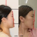 성인 주걱턱 교정기로 턱 넣는 비용은?