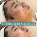 화서1동 | 화서동피부관리 플레브에스테틱 좁쌀화농성여드름 관리 잘하는 피부샵추천