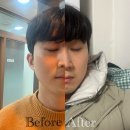 해림사우나 | 논현 온다리프팅 남자친구추천시술 솔직 후기