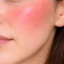 이메디컴 | 피부 열감 원인 홍조팩 피나코딜 카멘시트 출시 붙이는법