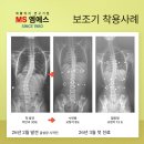 이마트24 구로MS점 | 46도 교정 사례 후기 모음 척추측만증(척추옆굽음증) MS엠에스 보조기/교정기 서울 부산 여수 통영