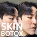 성수피부과 스킨보톡스 통증, 효과, 시술주기 내돈내산 후기 TIP.