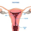 자궁용종 증상과 원인 예방 이미지