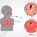 후두염 원인 후두염 기침 전염 후두염 목소리 전염 음식 이미지