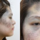 얼굴의 반 이상을 차지하며 피부암으로 까지 발전할 수 있는 난치성 질환은? 이미지
