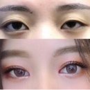 [공지] 인아웃라인 쌍꺼풀 수술 청담코지 성형외과 쌍수 망한 후기 없는 이유