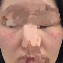 안강제일의원 | 포항 주근깨 시술, 주근깨제거 , 주근깨 레이저 후기 (내돈내산) 안강제일의원 -점빼기