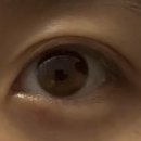 서울바램의원 | [모래내서울안과의원] 각막궤양 완치, 그리고 재발성 각막미란의 치료방법(예방)