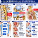 목디스크 C5-C6 손상, 팔과 손가락까지 저린다면? C6 신경근 증상과 재활운동 3가지 이미지