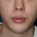압구정 로코코성형외과 코수술 4년뒤 후기