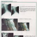 척수손상 MRI : 제4경추 전방 탈구 동영상 이미지