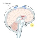 뇌수막염 이미지