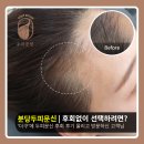 토브 스튜디오(Tobe Studio) | [분당두피문신] 두피문신 후회 더쿠 후기의 현실, 후회 없이 선택과 잔흔 커버의 현실