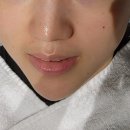 서정피부과:물광주사,LDM