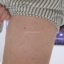 돈두구이 | [찐내돈내산 치료후기] 광고&amp;협찬 절대아님 편평사마귀 조져버리기 (제거 전후/한달후 비교사진)