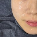 모아케어 | 용인 동백 에스테틱 모아모아 | 유리알케어 후기 (건조피부 물광 리얼 Before After)