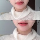 MY에스테틱 | [립퍼밍] 필러 없이 자연 볼륨 끝판왕 ㅣ부산 스킨릿 에스테틱 찐추천 후기