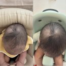 하니 | 하니헬멧 한달차 후기_교정헬멧, 사두교정