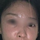 500돈 | [에버피부과] 쥬베룩 볼륨, 보톡스, 히알라제(필러녹이기)