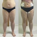 미약국 | 다이어트 시작 : 부천비만클리닉 렛미인 지방추출주사 (멍,붓기,통증,가격,후기)