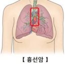 흉선종, 흉선암 및 (가슴흉통 잦은기침 호흡곤란) 이미지