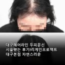 대구헤어라인 두피문신 시술했는 후기!리게인프로젝트 대구본점 자연스러운 밀도와 디자인 경험담