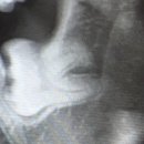 이용승치과의원 | 사랑니 발치 후기