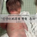 후케어 | 신생아 태열 지루성 피부염 아토피성 피부염 병원 다녀온 후 케어 후기