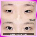 자연 | 광주쌍수후기 자연스러움이 중요한 이유