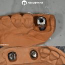 75플란트신동일치과의원 | 어금니 부분틀니 불편하신가요? 음성 치과 에서 튼튼한 임플란트로 해결해 드립니다.