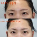 홍외과의원 | 드레스성형외과 짝눈교정 수술 망한후기