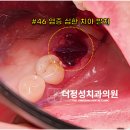 성남 365일 중원구 치과 더정성치과 어금니 통증 즉시로딩 임플란트로 치료해드린 임상 증례