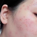 휴베이스교대365약국 | 얼굴 편평사마귀 150개 제거 후기 및 관리 1탄 | 통증·딱지·듀오덤 알러지 일주일차 솔직 기록...