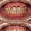 와동킴스치과의원 | 울산충치치료, 앞니충치 레진 VS 라미네이트? 고민 중이시라면 (실제 사례)