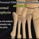 발가락 골절 - 제5중족골 기저부 골절 이미지