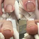 레푸스 | [춘천 레푸스 후기] 지긋지긋한 내성발톱 드디어 탈출..!! 5개월 관리 찐후기(스압주의)