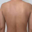 등임 | 광주 해율 한의원 : 등여드름 치료 마지막 후기