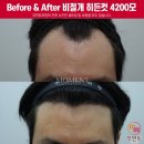 4200 | 심각한 M자탈모 40대 남성 비절개 모발이식 4200모 12개월 후기