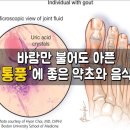 통풍에 좋은 약초 8가지 이미지