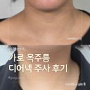 디어선 | 가로 목주름시술 디어넥주사 후기 목주름 관리 기록
