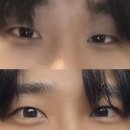 내차병원 | 부산 남자 쌍수 눈매교정 첫수술부터 재재수술까지 후기 내돈내산