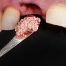 고려대학교 임상치의학대학원 | 임플란트 재수술 꼭 필요한 경우와 치료 과정