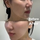 청담 피부과 추천!100kj 티타늄 리프팅 하고왔어요!! / 티타늄리프팅 솔직후기, 가격, 효과