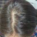 둔산대형약국 | [리뷰] 여성형탈모 극복기 1차후기(마이녹실S/엘리메르 헤어로스 앰플)