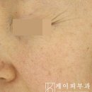 이유스킨 | 부산 리투오 스킨부스터 2회 효과 후기(레티젠 병행 이유)